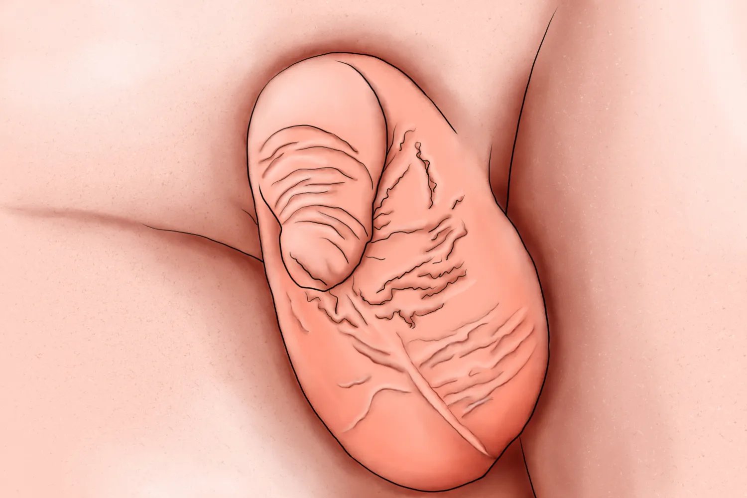 4个月宝宝包茎症状图片