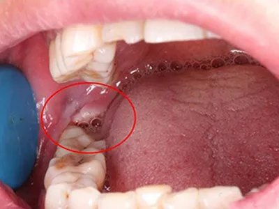 智齿冠周炎牙龈症状图片