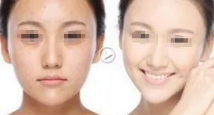 复合彩光除皱术需要多少钱