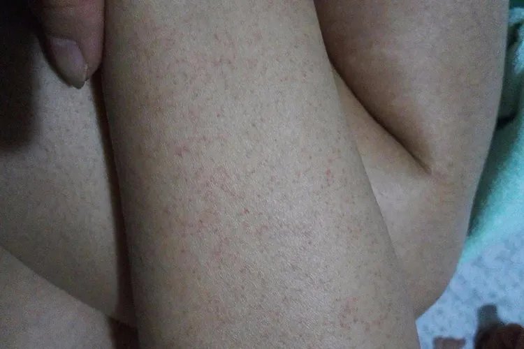 白血病的前兆是什么样的反应