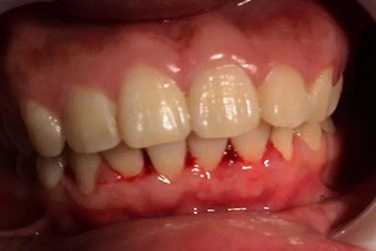 登革热出血图片