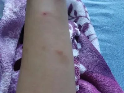 跳蚤叮咬疙瘩图片