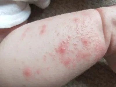 皮肤过敏红肿胳膊症状图片