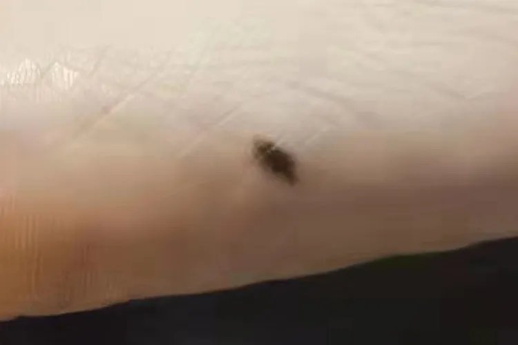 黑色素瘤早期症状图片