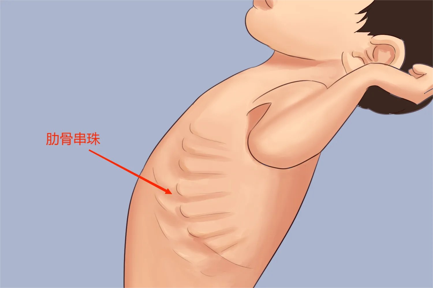 佝偻病是什么样子的图片