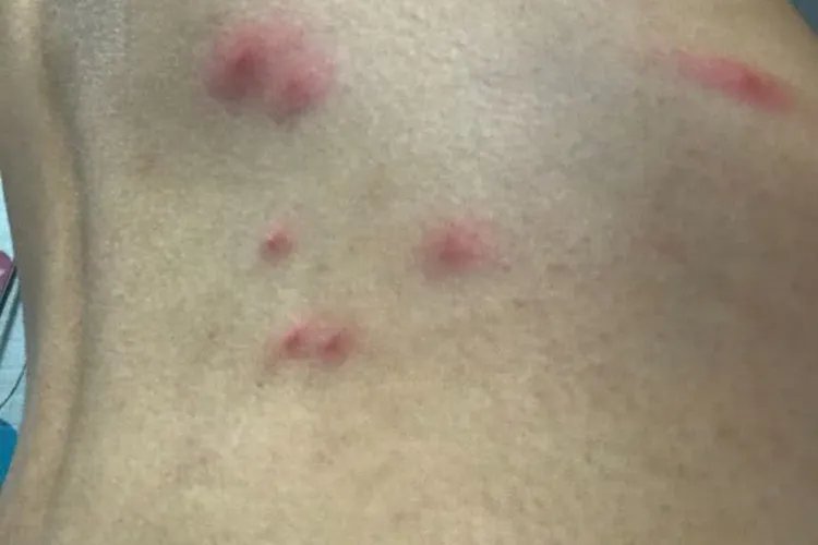 身上长了很多红色的包很痒图片