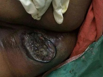 气性坏疽症状图片