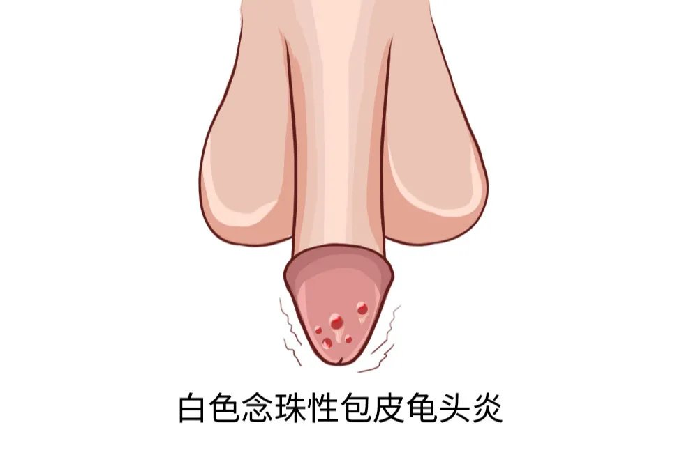 4种龟头炎图片
