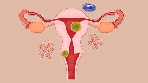 妇科支原体感染的症状有哪些