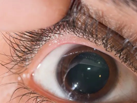 色素性视网膜炎的症状有哪些