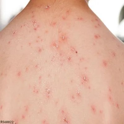 传染性软疣有何症状