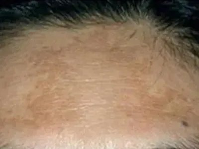 黄褐斑症状图片