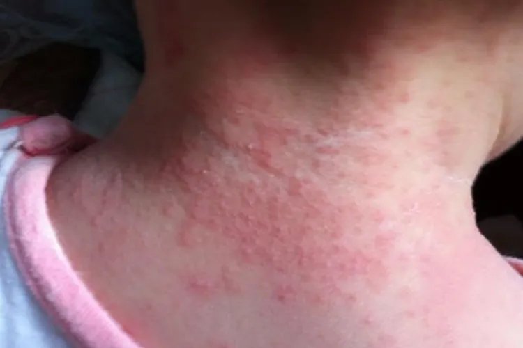 起皮疹图片