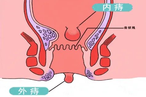痔疮外疮长什么样子的图片