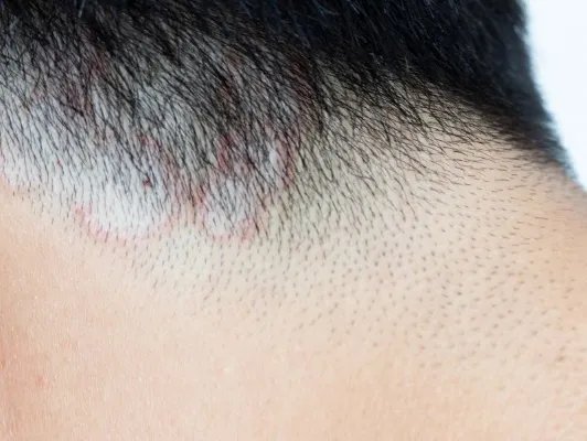 白癣皮的功效与作用