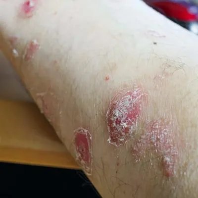 牛皮癣外用药哪样效果好