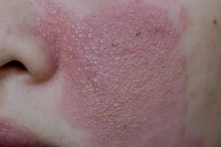 皮丘疹图片大全