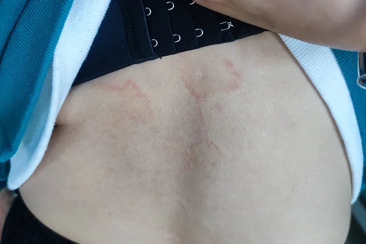 皮肤长霉菌斑图片