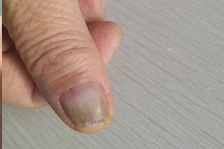 灰指甲是什么原因造成的图片