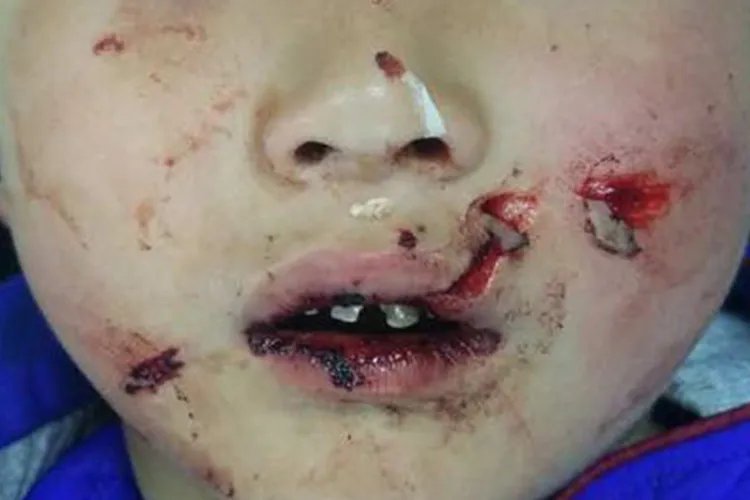 儿童自毁容貌症图片