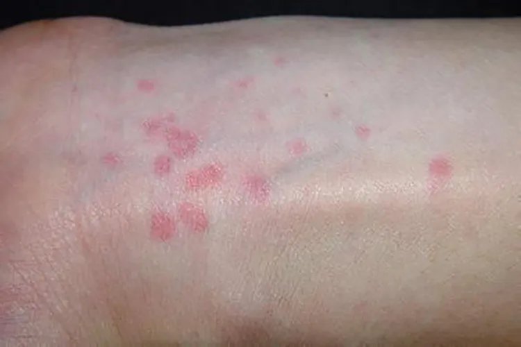 荨麻疹图片和症状图