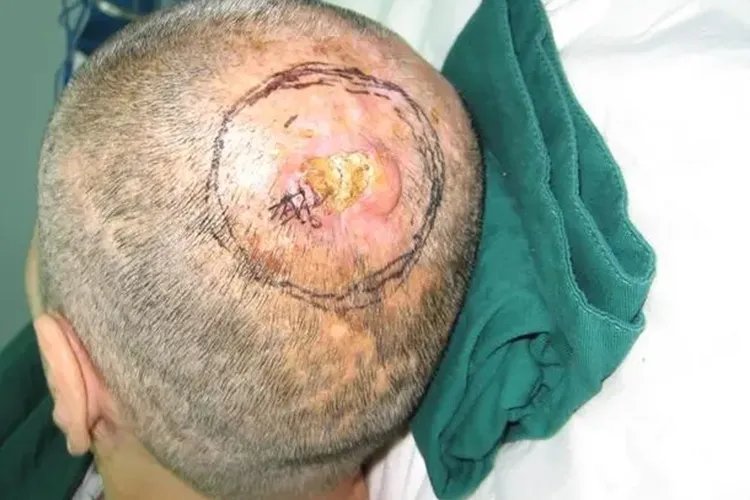 头皮鳞状细胞癌图片