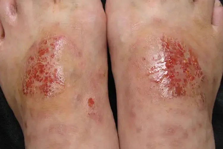湿性湿疹的症状图片