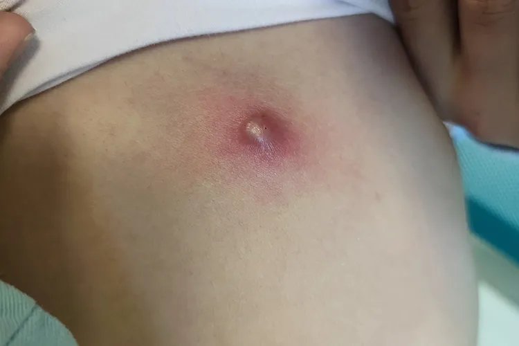 严重的毛囊炎图片