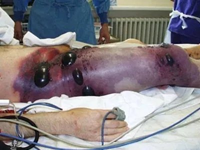 气性坏疽症状图片