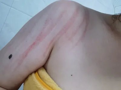 人工荨麻疹症状图片