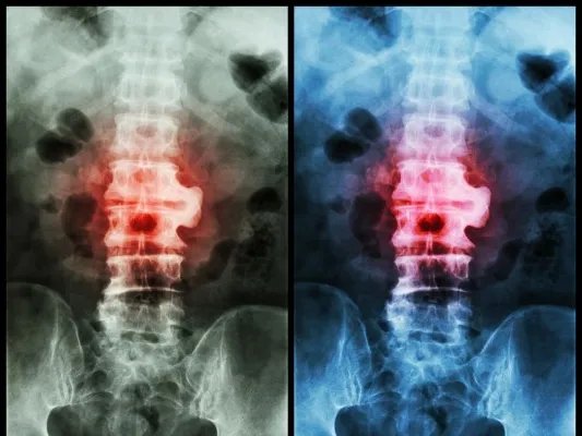 拔罐对颈椎病有用吗