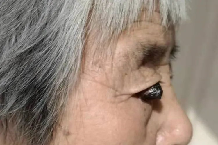 黑色素瘤早期症状图片