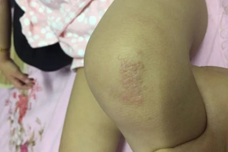 孩子身上湿疹图片