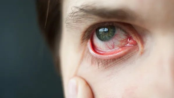 怎么去除眼睛红血丝 去除眼睛红血丝的5个小技巧