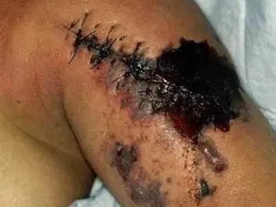 气性坏疽症状图片