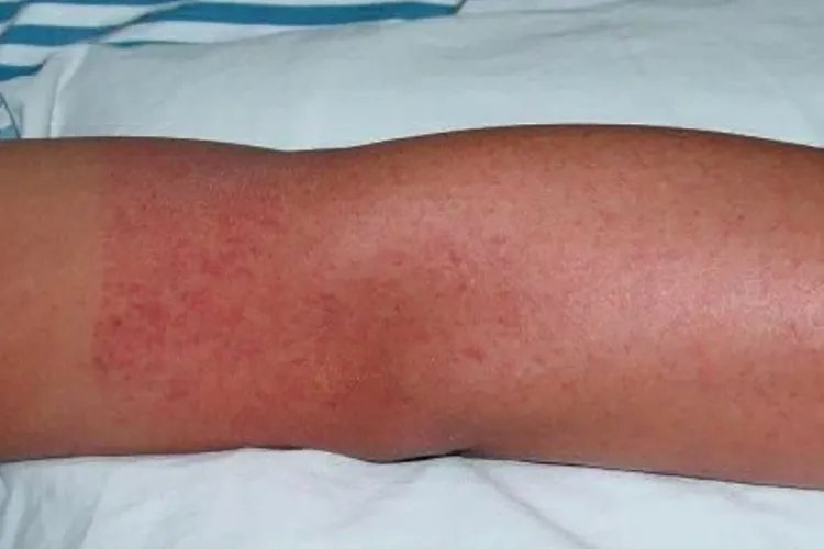 登革热被咬后的图片