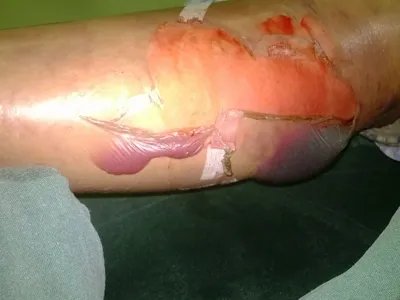 气性坏疽症状图片