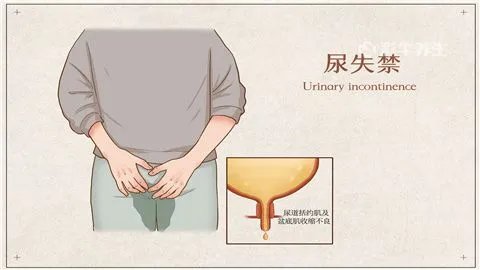 尿失禁怎么治疗呢