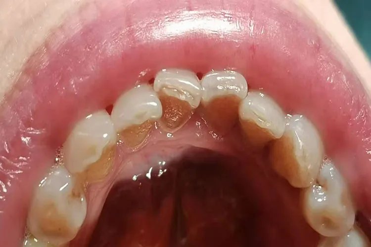 牙结石是什么样的图片危害