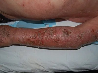 皮肤过敏红肿胳膊症状图片