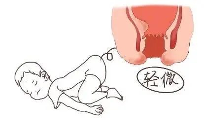 儿童轻微痔疮图片