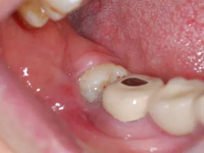 智齿冠周炎牙龈症状图片