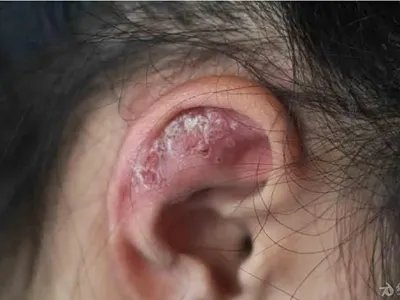 盘状红斑狼疮红斑图片