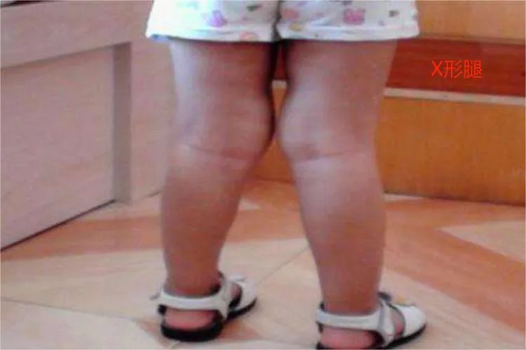 佝偻病是什么样子的图片