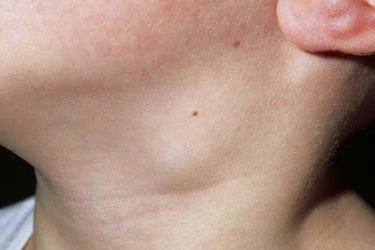 儿童脖子淋巴瘤早期图片