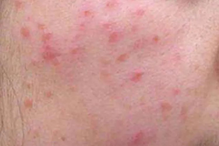 脸过敏的症状是什么样子的