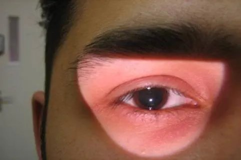 瞳孔散大图片大全