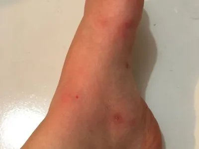 跳蚤叮咬疙瘩图片