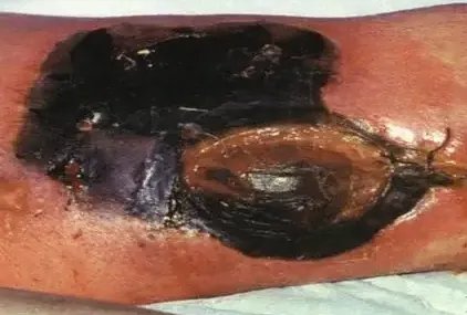 气性坏疽症状图片