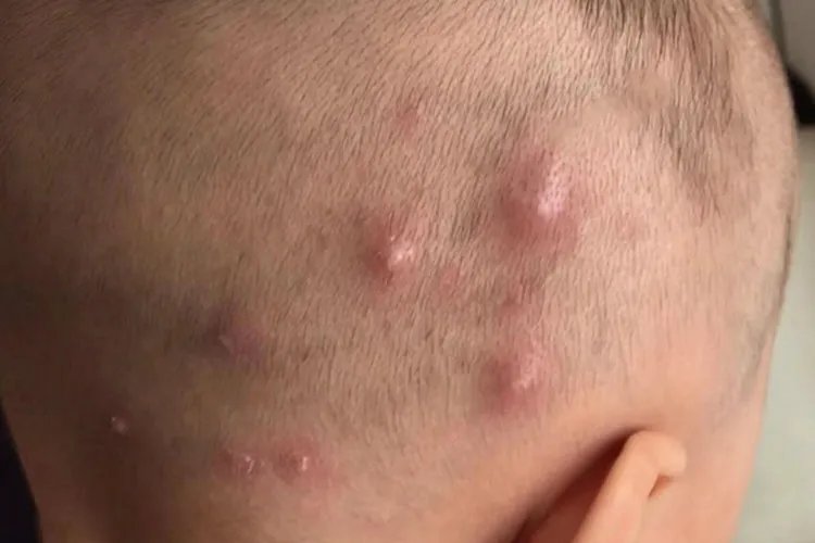 严重的毛囊炎图片